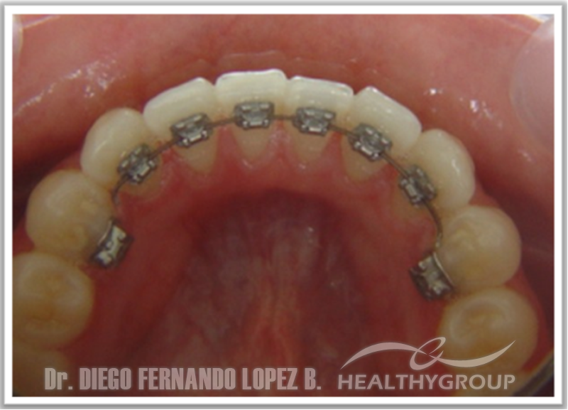 ortodoncia-lingual-5497.png ortodoncia-lingual-5497.png